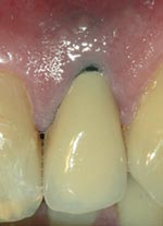 Renishaw Fig 1 Metal crown tooth