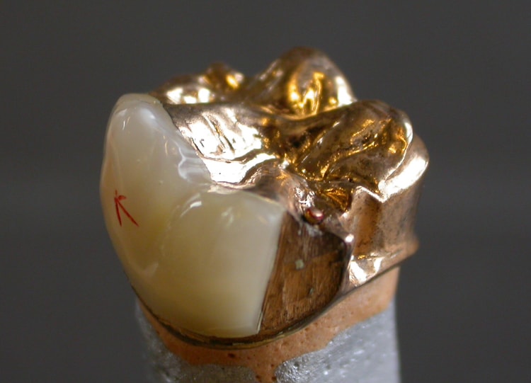 Close up of gold dental crown